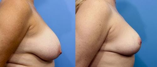 Breast Reduction Before & After Gallery - Patient 58179167 - Image 2