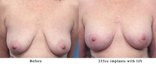 Breast Lift with Augmentation Before & After Gallery - Patient 58179170 - Image 1