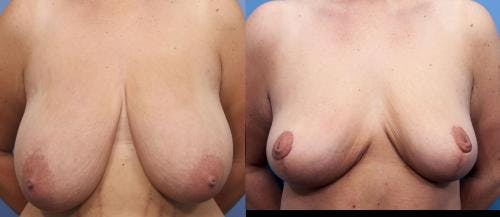 Breast Reduction Before & After Gallery - Patient 58179168 - Image 1