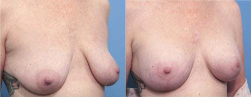 Breast Lift with Augmentation Before & After Gallery - Patient 58179170 - Image 2