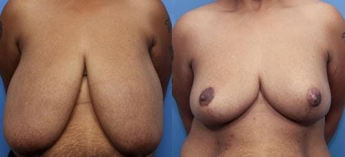 Breast Reduction Before & After Gallery - Patient 58179169 - Image 1