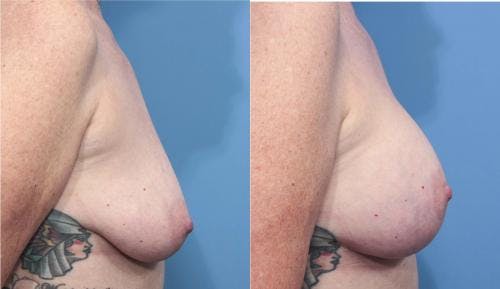 Breast Lift with Augmentation Before & After Gallery - Patient 58179170 - Image 3