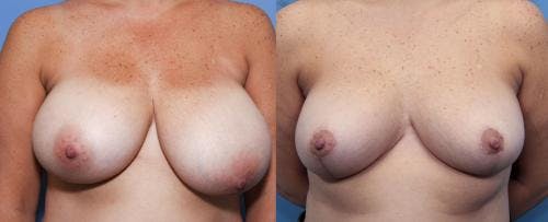 Breast Reduction Before & After Gallery - Patient 58179172 - Image 1
