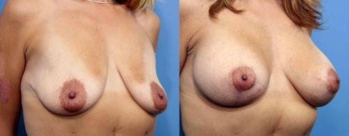 Breast Lift with Augmentation Before & After Gallery - Patient 58179174 - Image 2