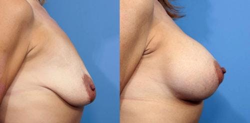 Breast Lift with Augmentation Before & After Gallery - Patient 58179174 - Image 3