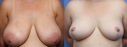 Breast Reduction Before & After Gallery - Patient 58179173 - Image 1