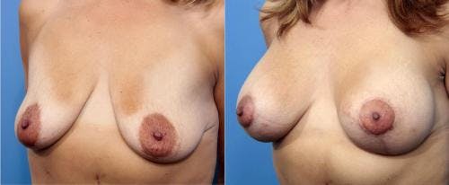 Breast Lift with Augmentation Before & After Gallery - Patient 58179174 - Image 4