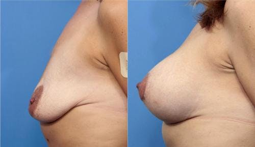 Breast Lift with Augmentation Before & After Gallery - Patient 58179174 - Image 5