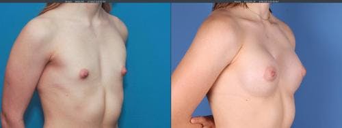 Correction of Tuberous Breast Before & After Gallery - Patient 58190572 - Image 2