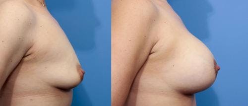 Breast Lift with Augmentation Before & After Gallery - Patient 58195619 - Image 5