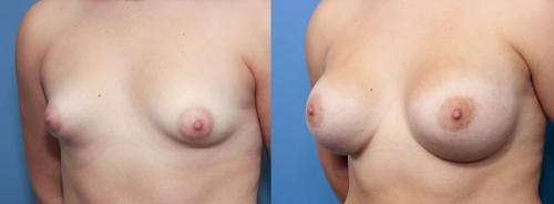 Correction of Tuberous Breast Before & After Gallery - Patient 58195620 - Image 2