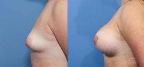 Correction of Tuberous Breast Before & After Gallery - Patient 58195620 - Image 3