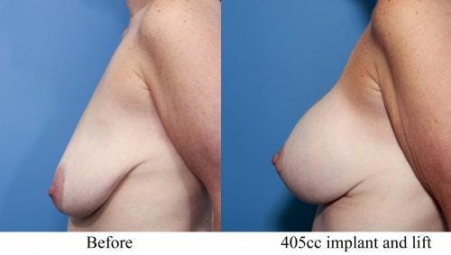 Breast Lift with Augmentation Before & After Gallery - Patient 58195621 - Image 2