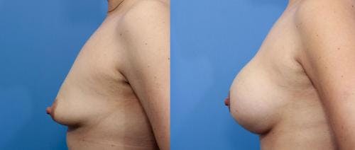 Correction of Tuberous Breast Before & After Gallery - Patient 58195631 - Image 2