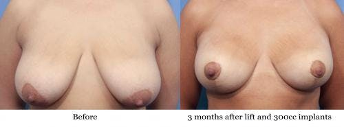 Breast Lift with Augmentation Before & After Gallery - Patient 58195630 - Image 1