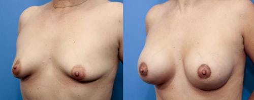 Correction of Tuberous Breast Before & After Gallery - Patient 58195631 - Image 3