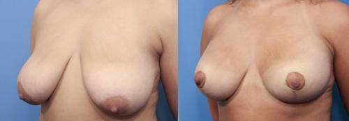 Breast Lift with Augmentation Before & After Gallery - Patient 58195630 - Image 2