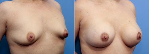 Correction of Tuberous Breast Before & After Gallery - Patient 58195631 - Image 4