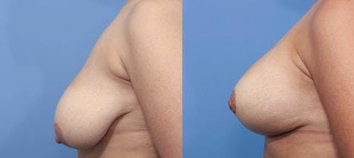 Breast Lift with Augmentation Before & After Gallery - Patient 58195630 - Image 3
