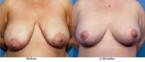 Breast Lift with Augmentation Before & After Gallery - Patient 58195632 - Image 1