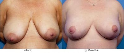 Breast Lift with Augmentation Before & After Gallery - Patient 58195632 - Image 1
