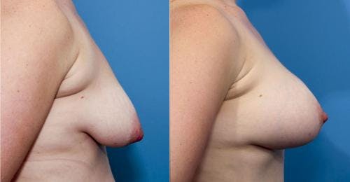 Correction of Tuberous Breast Before & After Gallery - Patient 58195634 - Image 2