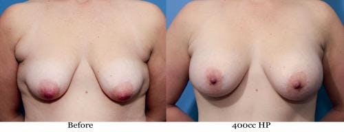 Correction of Tuberous Breast Before & After Gallery - Patient 58195634 - Image 1