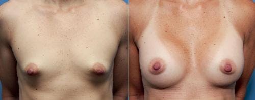 Correction of Tuberous Breast Before & After Gallery - Patient 58195636 - Image 1
