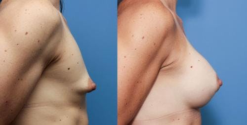 Correction of Tuberous Breast Before & After Gallery - Patient 58195636 - Image 2