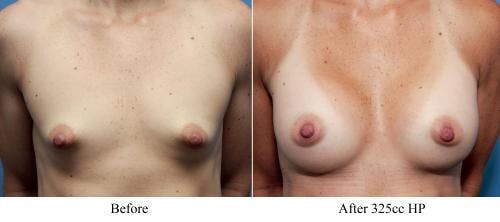 Correction of Tuberous Breast Before & After Gallery - Patient 58195636 - Image 3