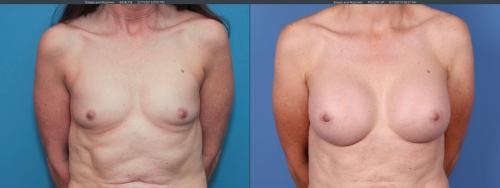 Breast Augmentation Before & After Gallery - Patient 58195637 - Image 1