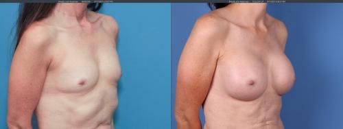 Breast Augmentation Before & After Gallery - Patient 58195637 - Image 2