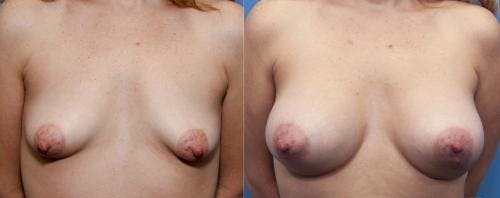 Correction of Tuberous Breast Before & After Gallery - Patient 58195638 - Image 1
