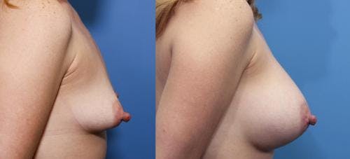 Correction of Tuberous Breast Before & After Gallery - Patient 58195638 - Image 2