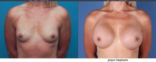 Breast Augmentation Before & After Gallery - Patient 58195640 - Image 1