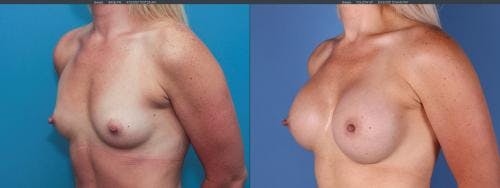 Breast Augmentation Before & After Gallery - Patient 58195640 - Image 2