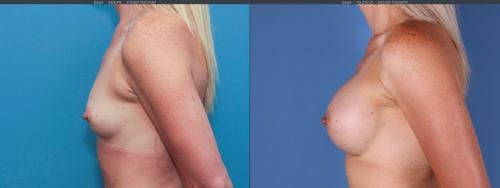 Breast Augmentation Before & After Gallery - Patient 58195640 - Image 3