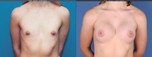 Breast Augmentation Before & After Gallery - Patient 58195642 - Image 1