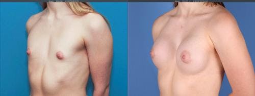 Breast Augmentation Before & After Gallery - Patient 58195642 - Image 3