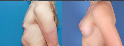 Breast Augmentation Before & After Gallery - Patient 58195642 - Image 4