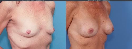 Breast Augmentation Before & After Gallery - Patient 58195643 - Image 1