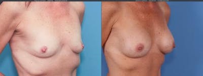 Breast Augmentation Before & After Gallery - Patient 58195643 - Image 1