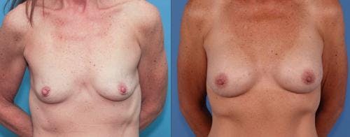Breast Augmentation Before & After Gallery - Patient 58195643 - Image 2