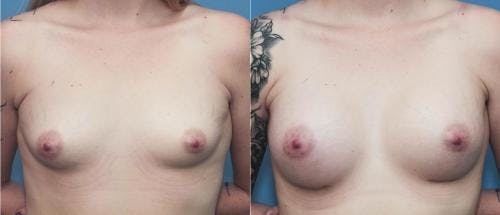 Breast Augmentation Before & After Gallery - Patient 58195645 - Image 1