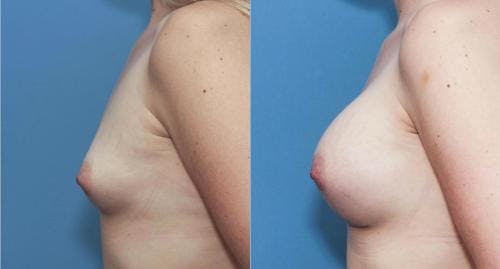 Breast Augmentation Before & After Gallery - Patient 58195645 - Image 3