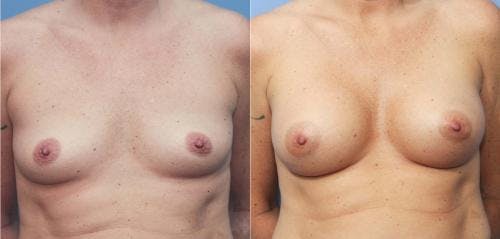 Breast Augmentation Before & After Gallery - Patient 58213170 - Image 1