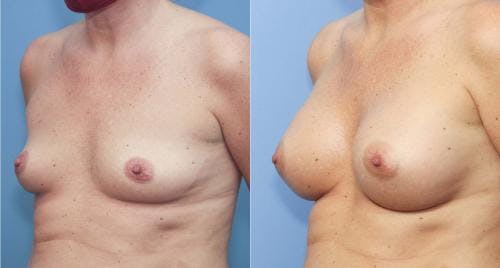 Breast Augmentation Before & After Gallery - Patient 58213170 - Image 2