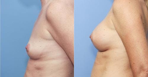 Breast Augmentation Before & After Gallery - Patient 58213170 - Image 3