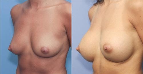 Breast Augmentation Before & After Gallery - Patient 58213172 - Image 2