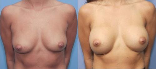 Breast Augmentation Before & After Gallery - Patient 58213172 - Image 1